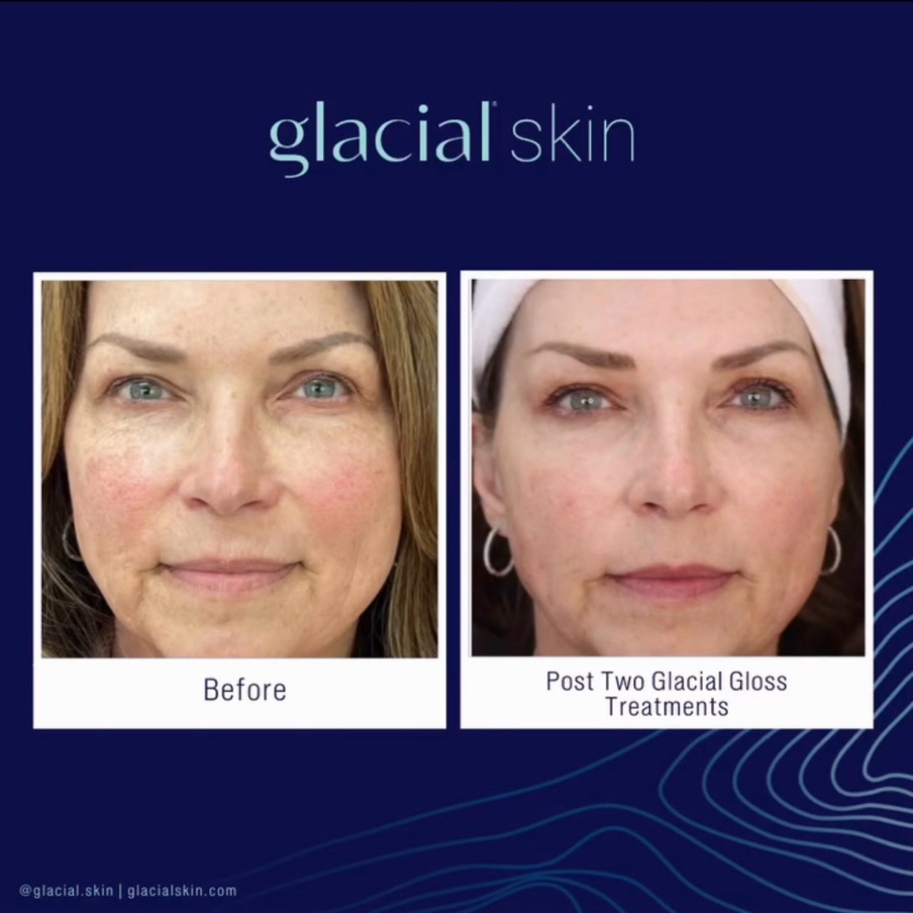 Glacial Glide - Add-On at SKIN CLINIC in Laguna Hills, CA