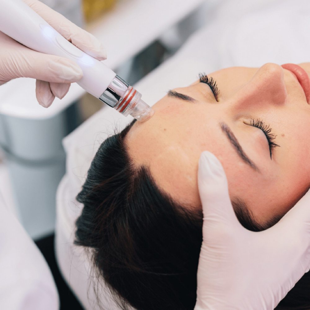 Microneedling at Beauty Lounge Prosper in McKinney, TX