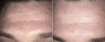 ReZENerate Facial