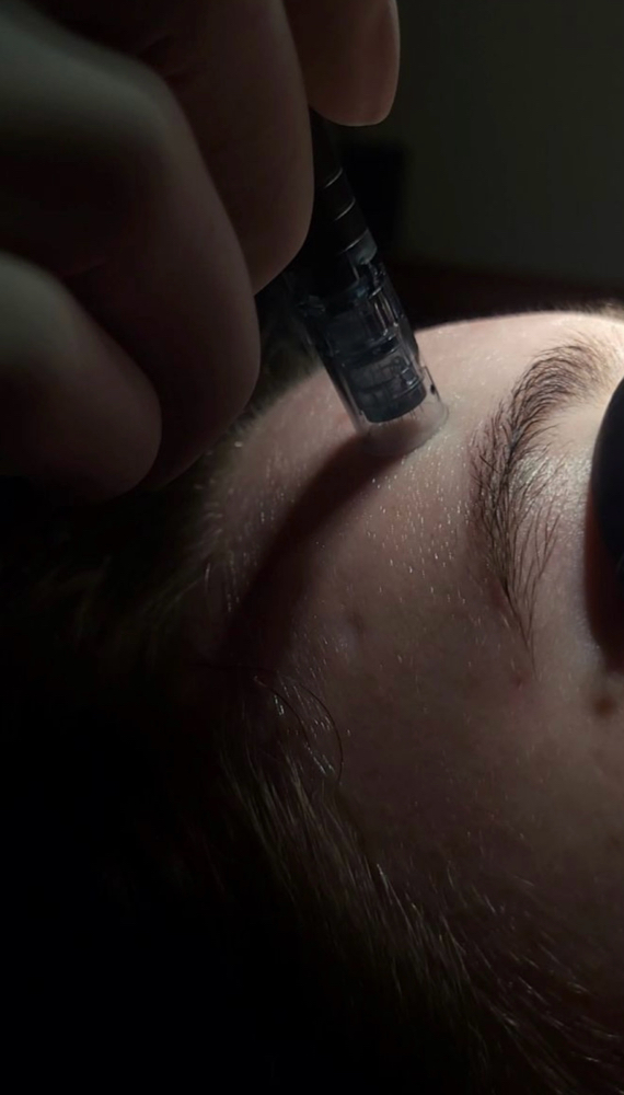 Microneedling