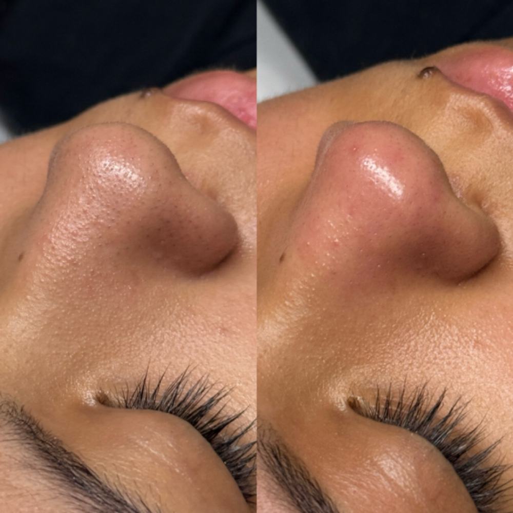 Extractions 👉🏼💢👈🏼 at Studio Blanc in Richardson, TX