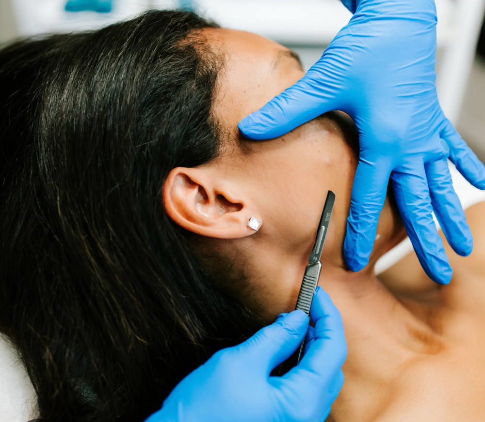 Dermaplane at Indulgence Beauty LLC in Tacoma, WA
