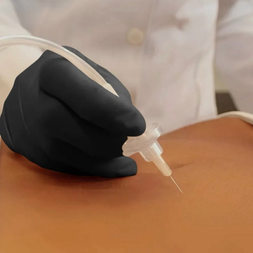Fibrosis Treatment With Carboxy at Lymphatic Post-Op Spa in San Diego, CA