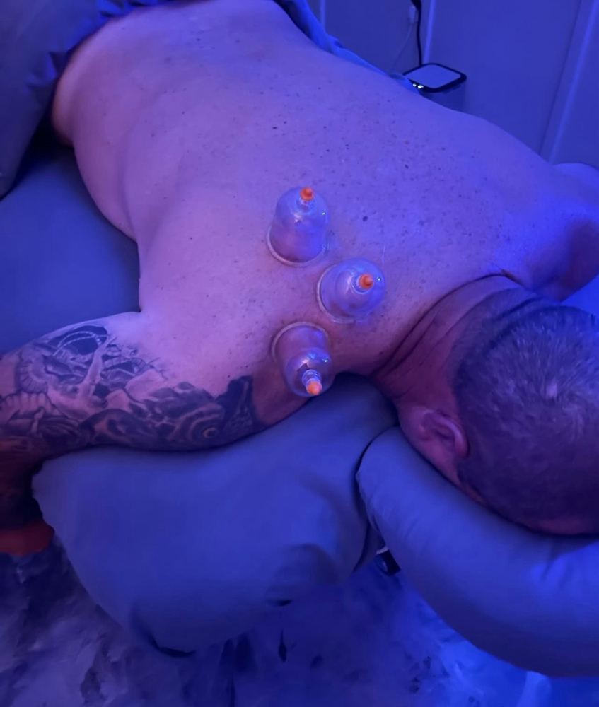 Cupping