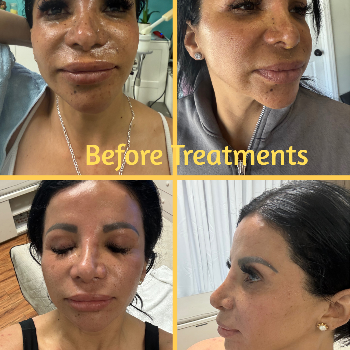 Pigmentation Facial Treatment at Oasis Healing Esthetics in Los Angeles, CA