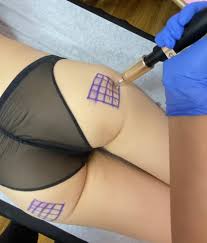 Butt Filler