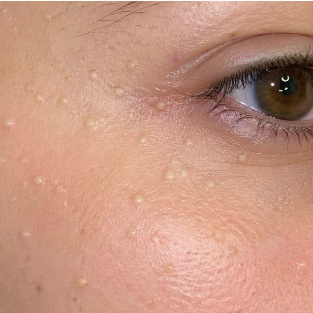 Extended Extractions/Milia Removal at Essential Esthetics Spa, LLC in Parker, CO