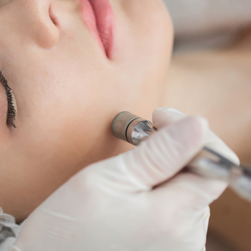 Microdermabrasion