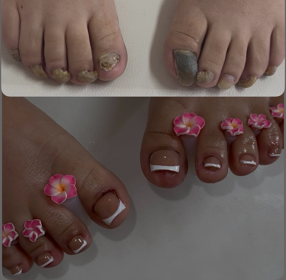 Severe TOE BBL