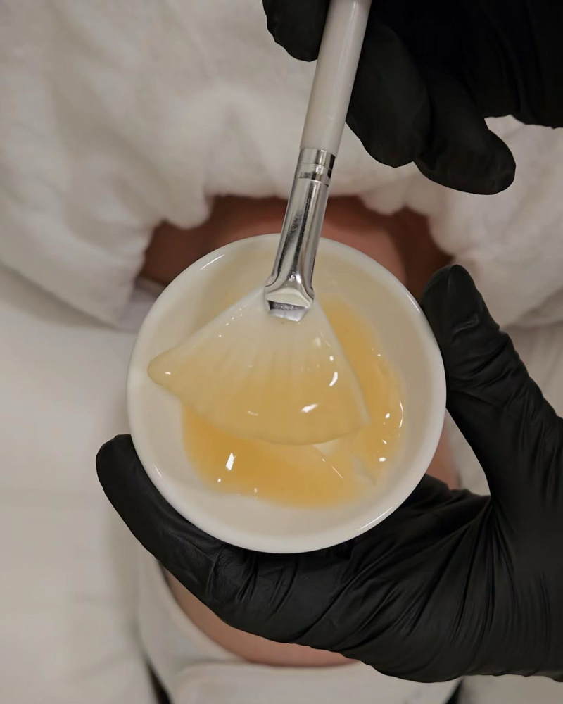 Modified Jessner 14% Peel at Iris Organic Spa in Dunedin, FL