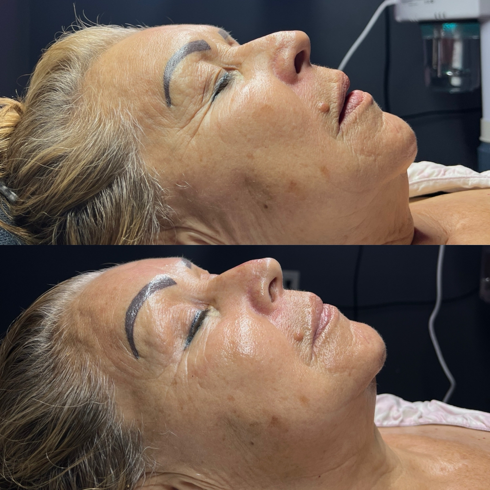 anti-aging facial