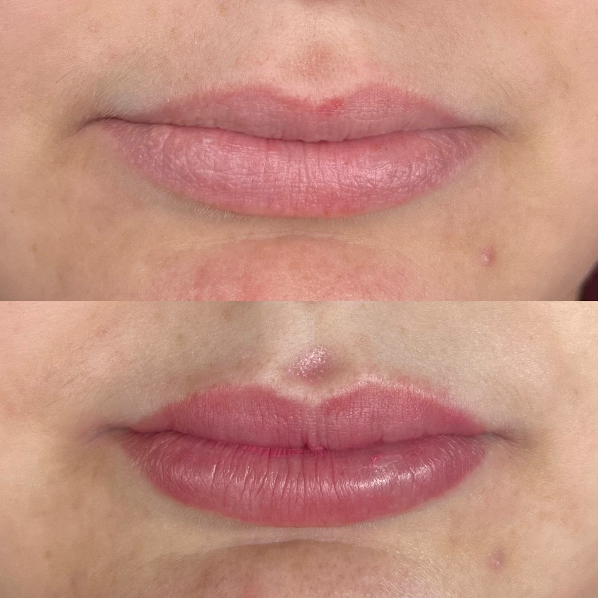 Lip Refinement/6 WeekFollow up