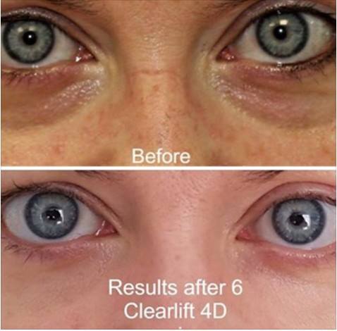 ClearLift™ Eyelift Laser Treatment