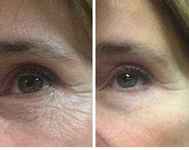 Laser Eye Lift & Wrinkle Repair