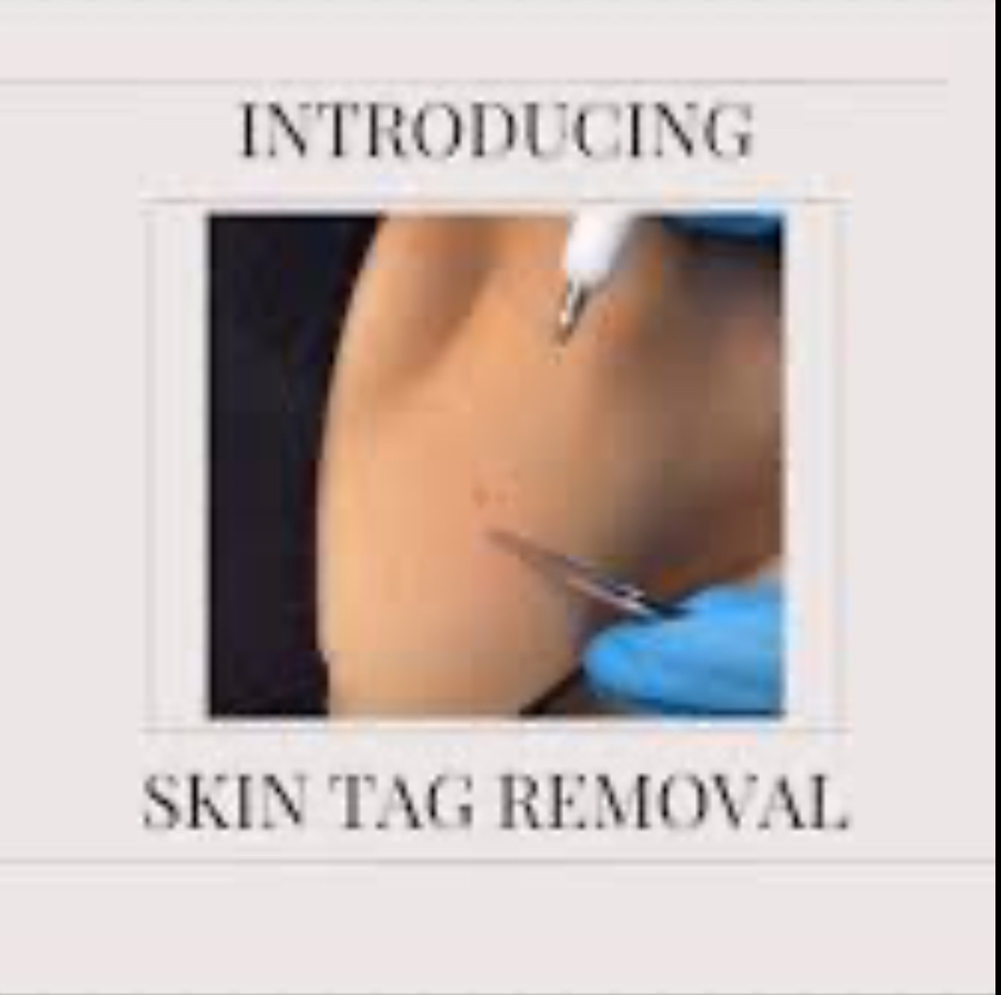 Skin Tag removal