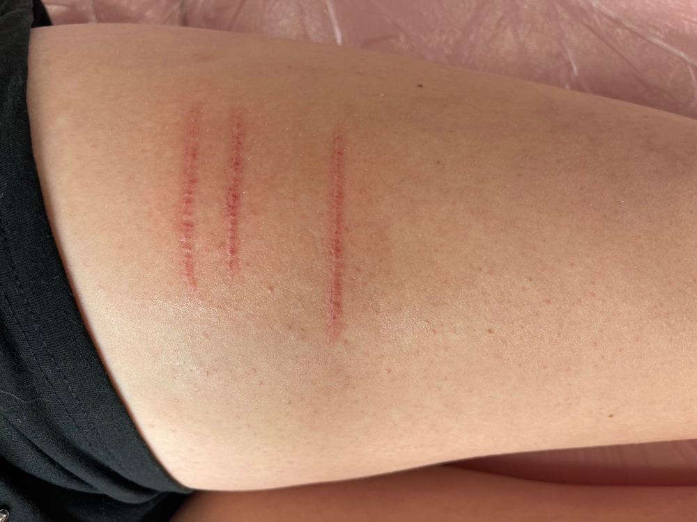 Scar Rejuvenation