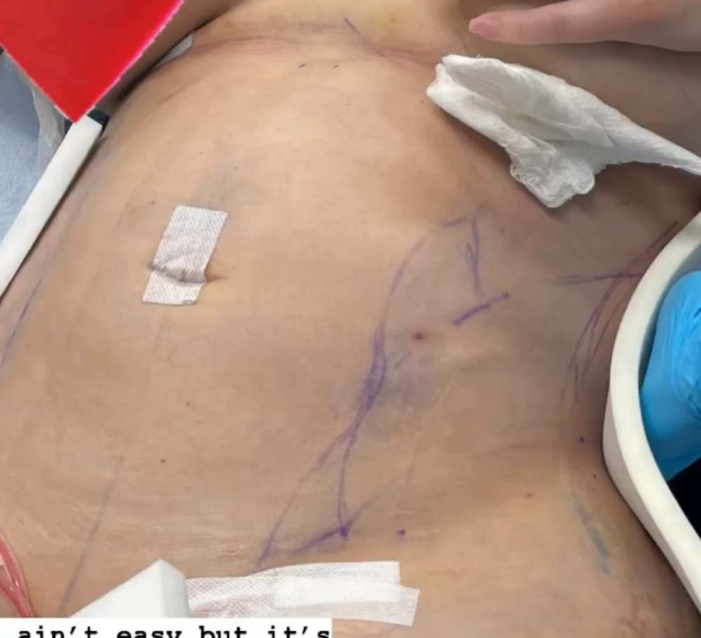 Post op maintenence