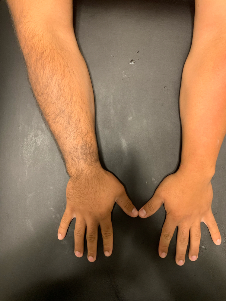 Arm Sugar