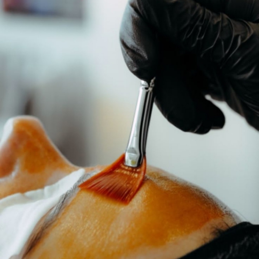 Skin Renewal Peel Series at Bella Glow Skin and Body in San Antonio, TX