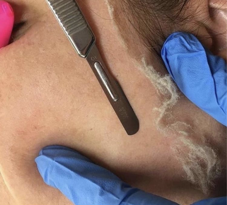 Dermaplaning Only