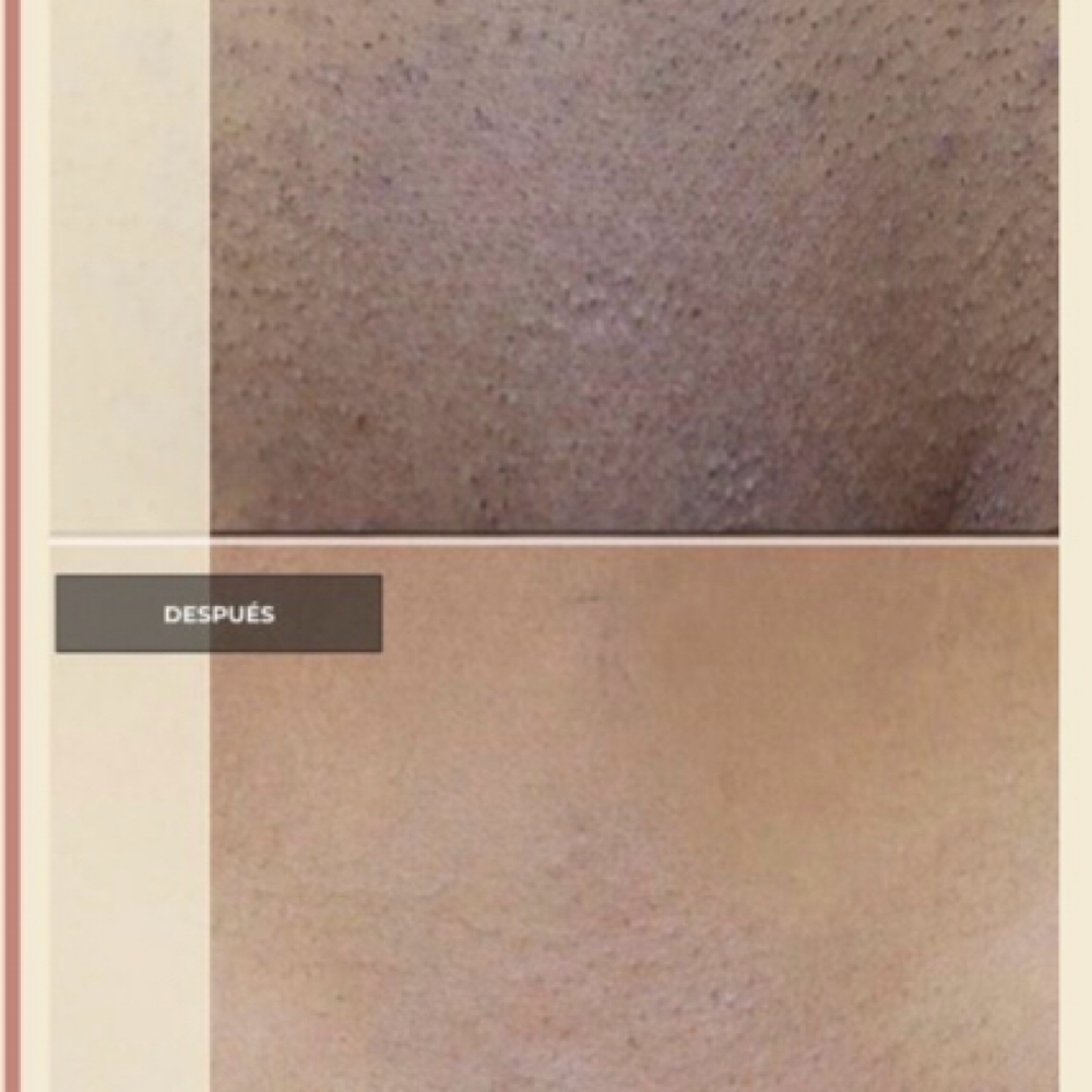 Vaginal Bleaching at Esthetics by bren in Poplar Grove, IL