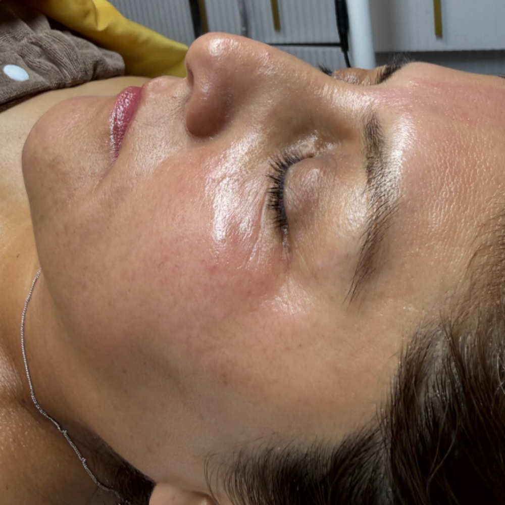 PDRN 🧬 esperma De salmón at Any Beauty Aesthetics Care in New York, NY