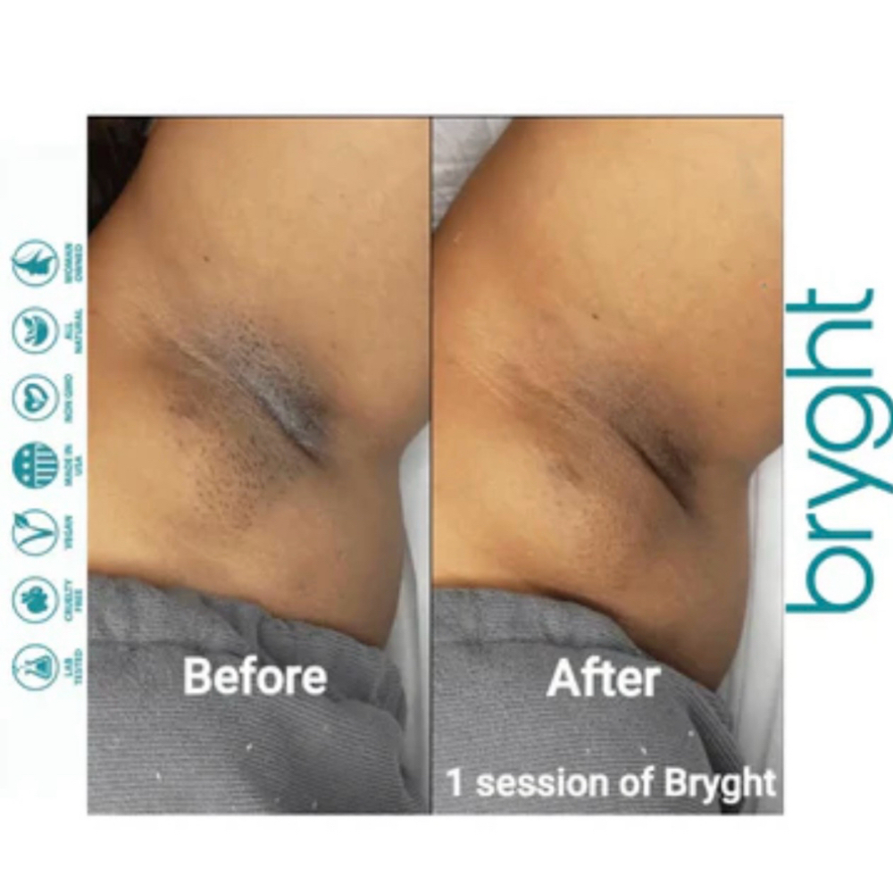 Bryght Treatment at Vivas Body Waxing in Milwaukee, WI