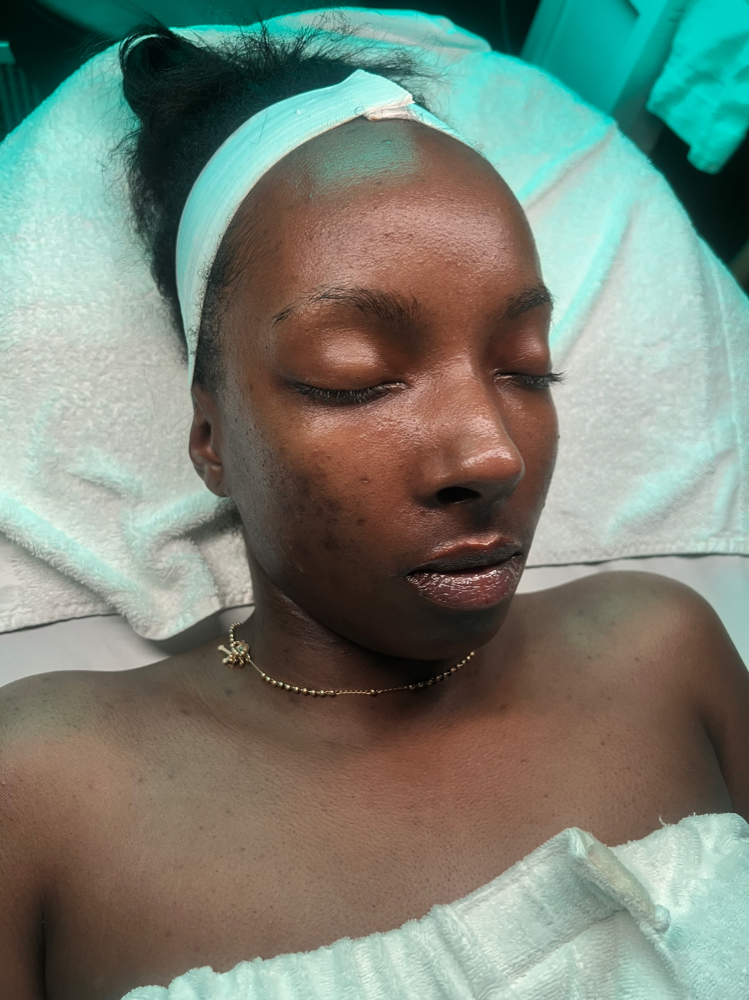 Acne Rescue Facial