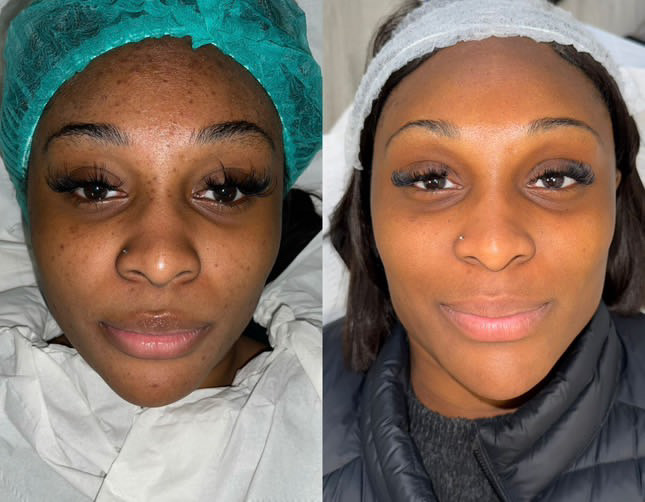 Organo Herbal Peel at ZoGlo Esthetics in Goose Creek, SC