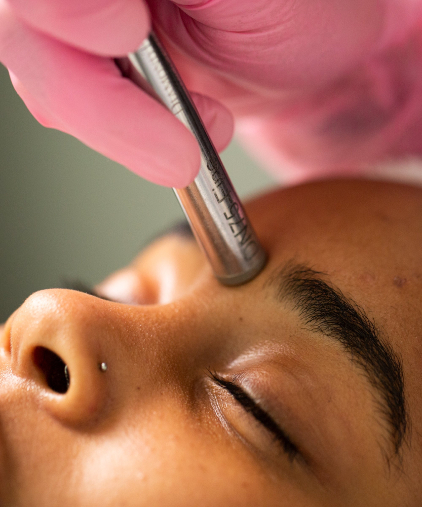 Diamond Microdermabrasion