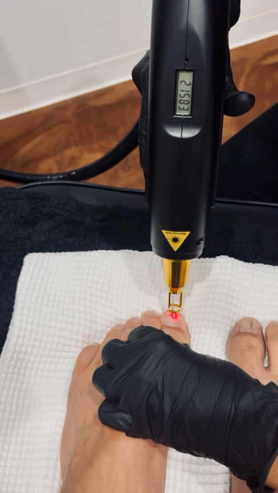 Fingernail & Toenail Fungus Removal