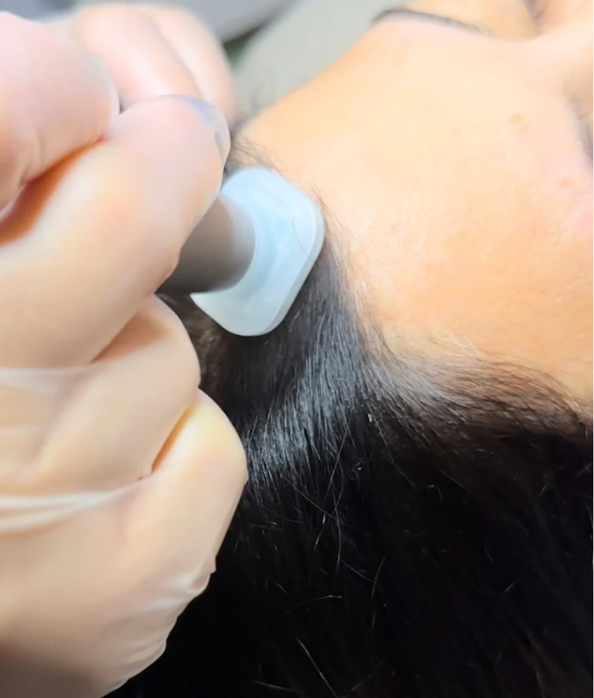 Jet Plasma Hair Restoration