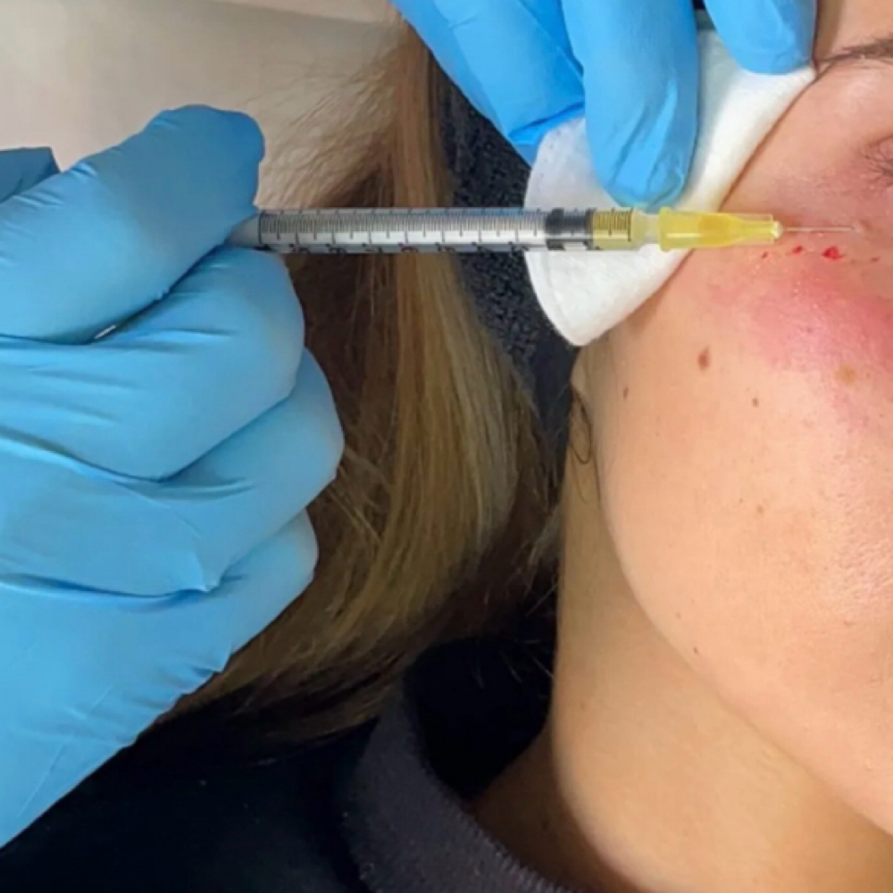 PRP- Undereyes (series Of 3) at M.LO aesthetics + wellness in Waukesha, WI