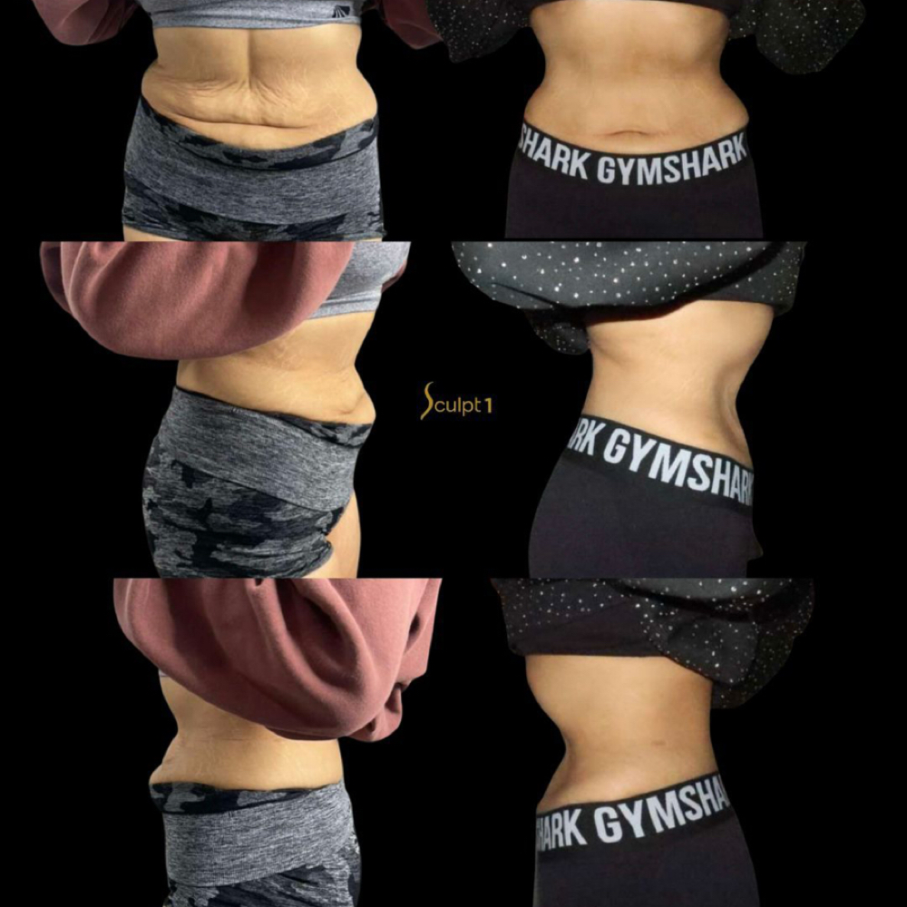 Skin Tightening And Cavitation at Davis Wellness & Aesthetics in Cleburne, TX