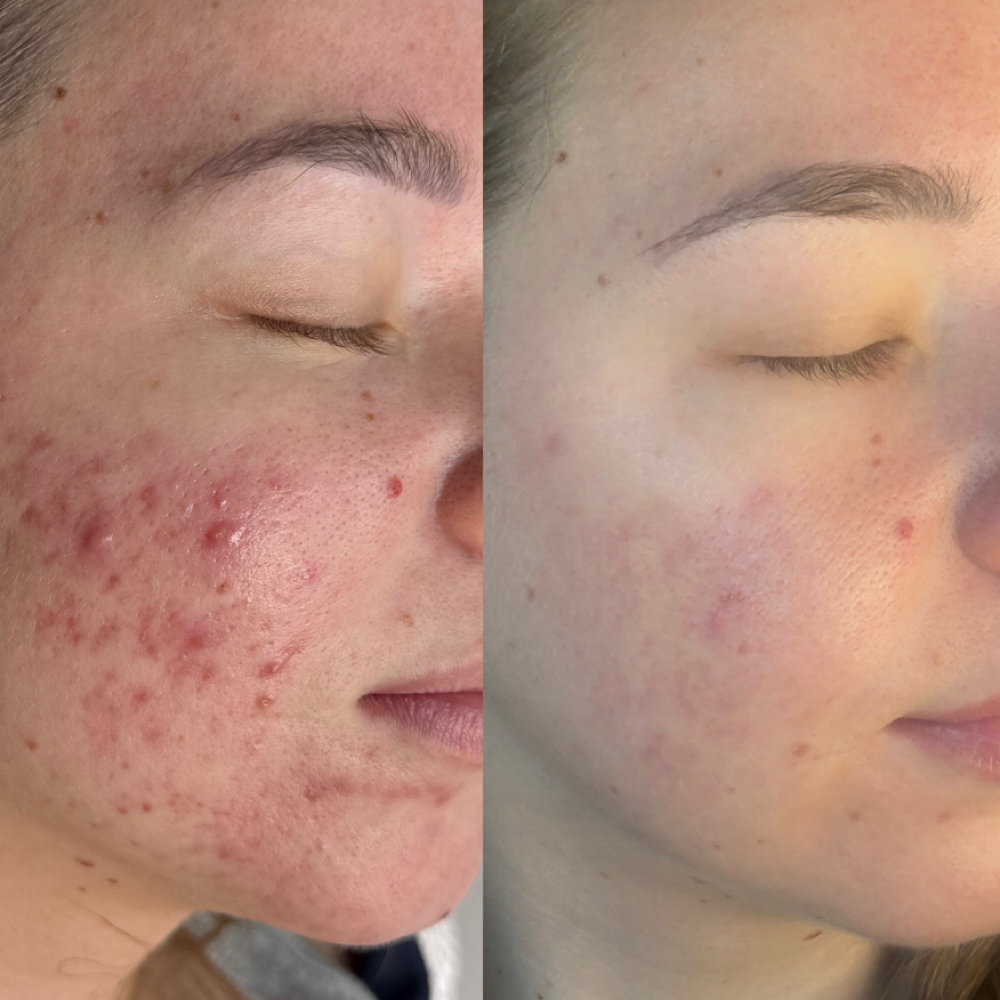 Acne Bootcamp at Lexibelleskin in St George, UT