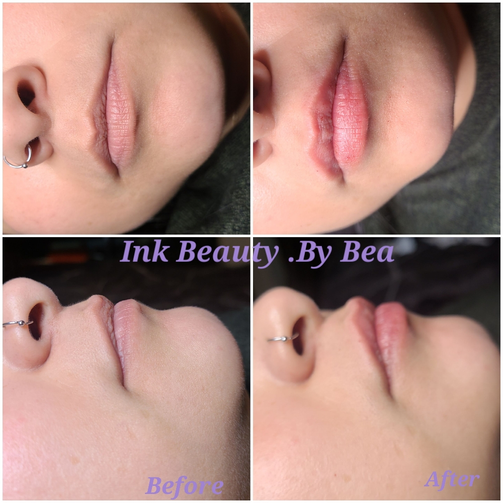 Lip Fillers: Pouty Beauty Lip