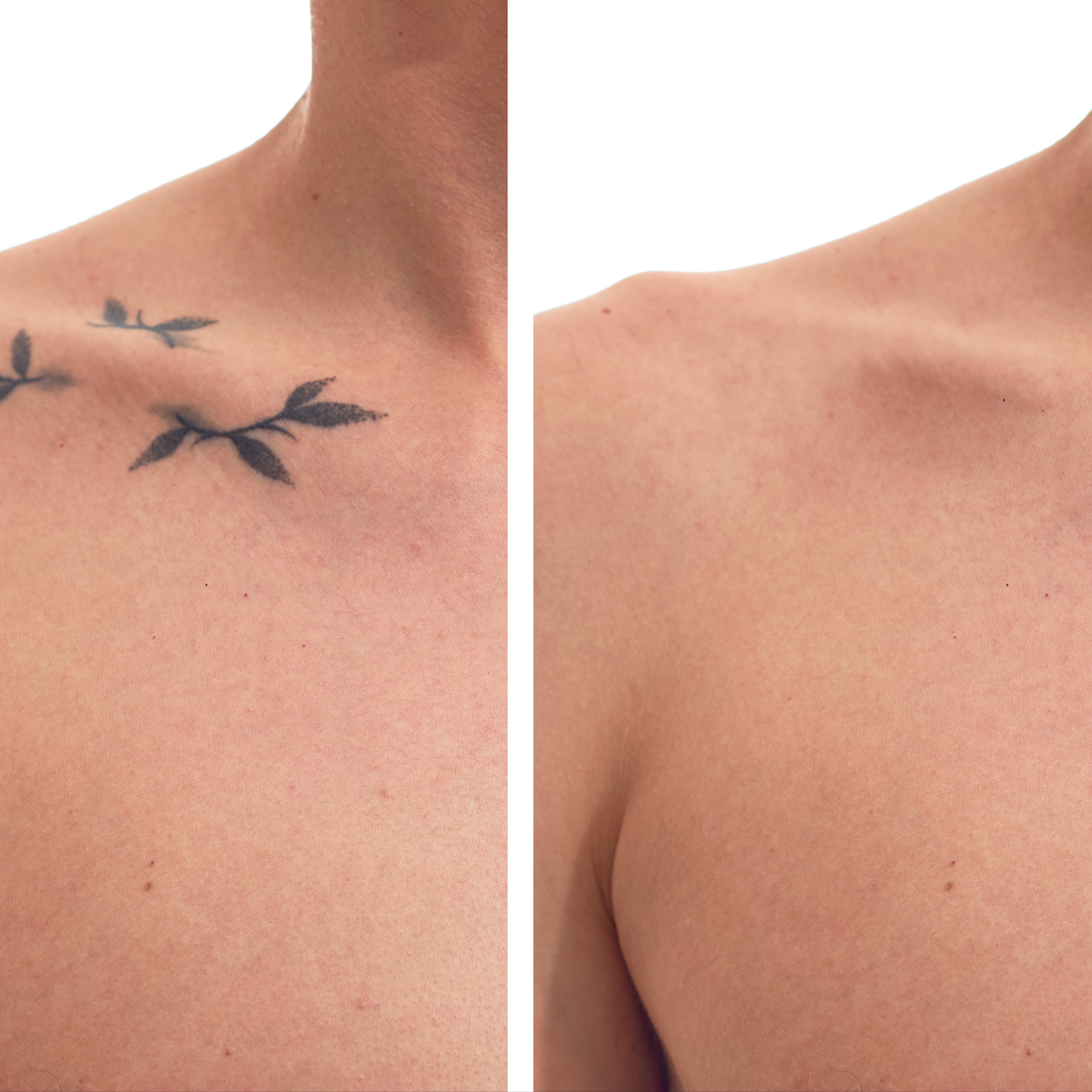 Tattoo Removal Consultation at 360 Med Spa Buford in Buford, GA