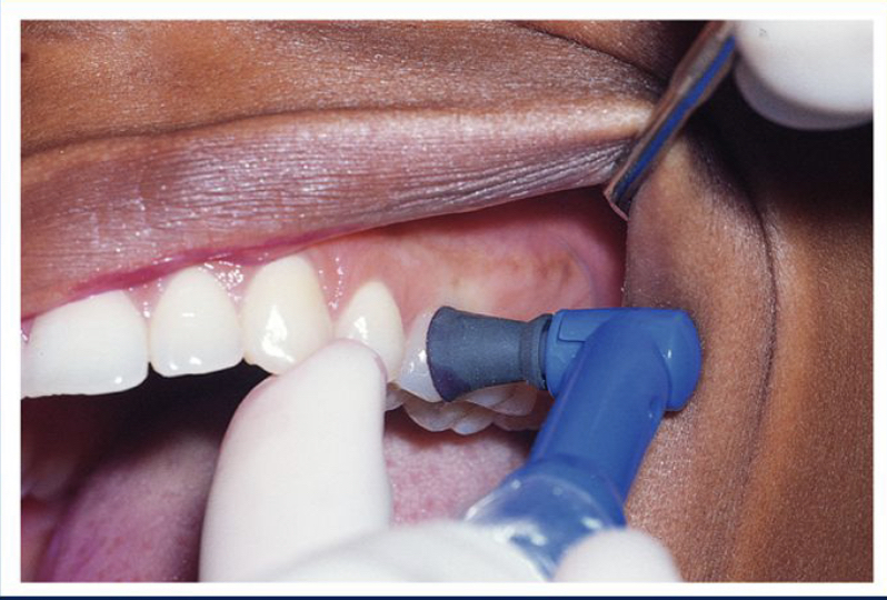 Exclusive Coronal Polish