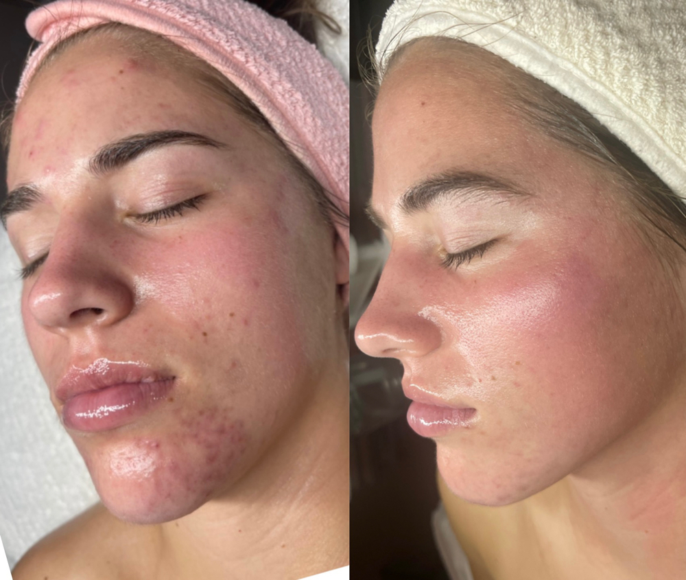 FIRST TIME ACNE CLIENT