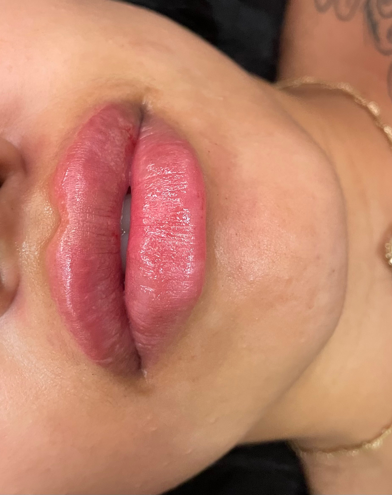MICRO NEEDLE Lip Filler