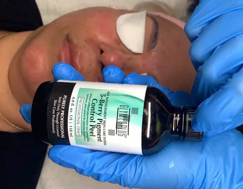 5 Berry Pigment Control Peel