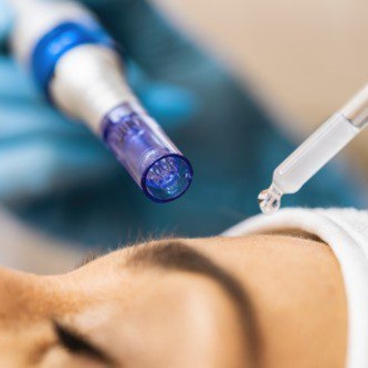 Regenerative Microneedling – PDRN at Face & Grace Aesthetics in Temecula, CA