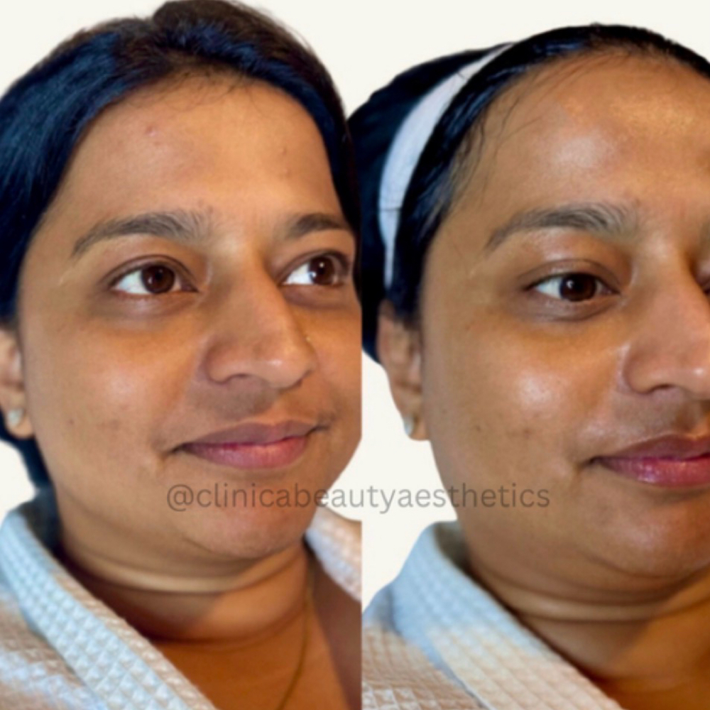 Customizable Clinica Facial at Clinica Beauty Aesthetics by Erica, RN in Texas, TX