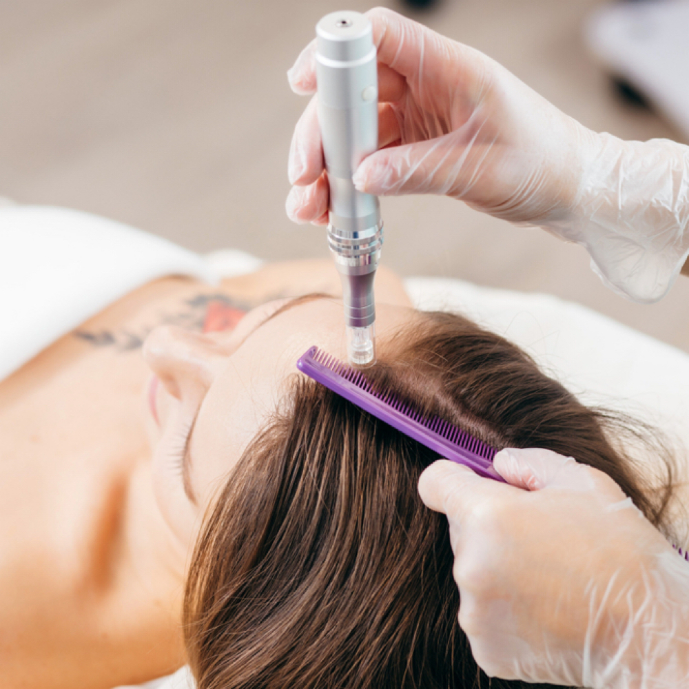 Hairline Renewal Treatment at Wilde Skin Rejuvenation in Heber City, UT