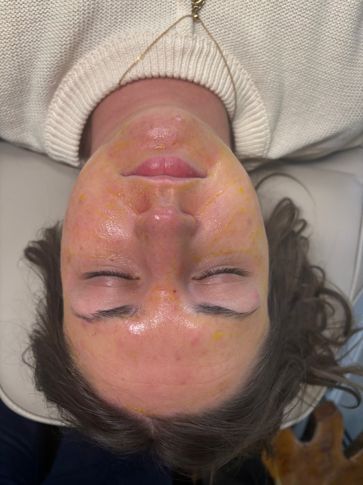 BioRePeel Microneedling + Peel