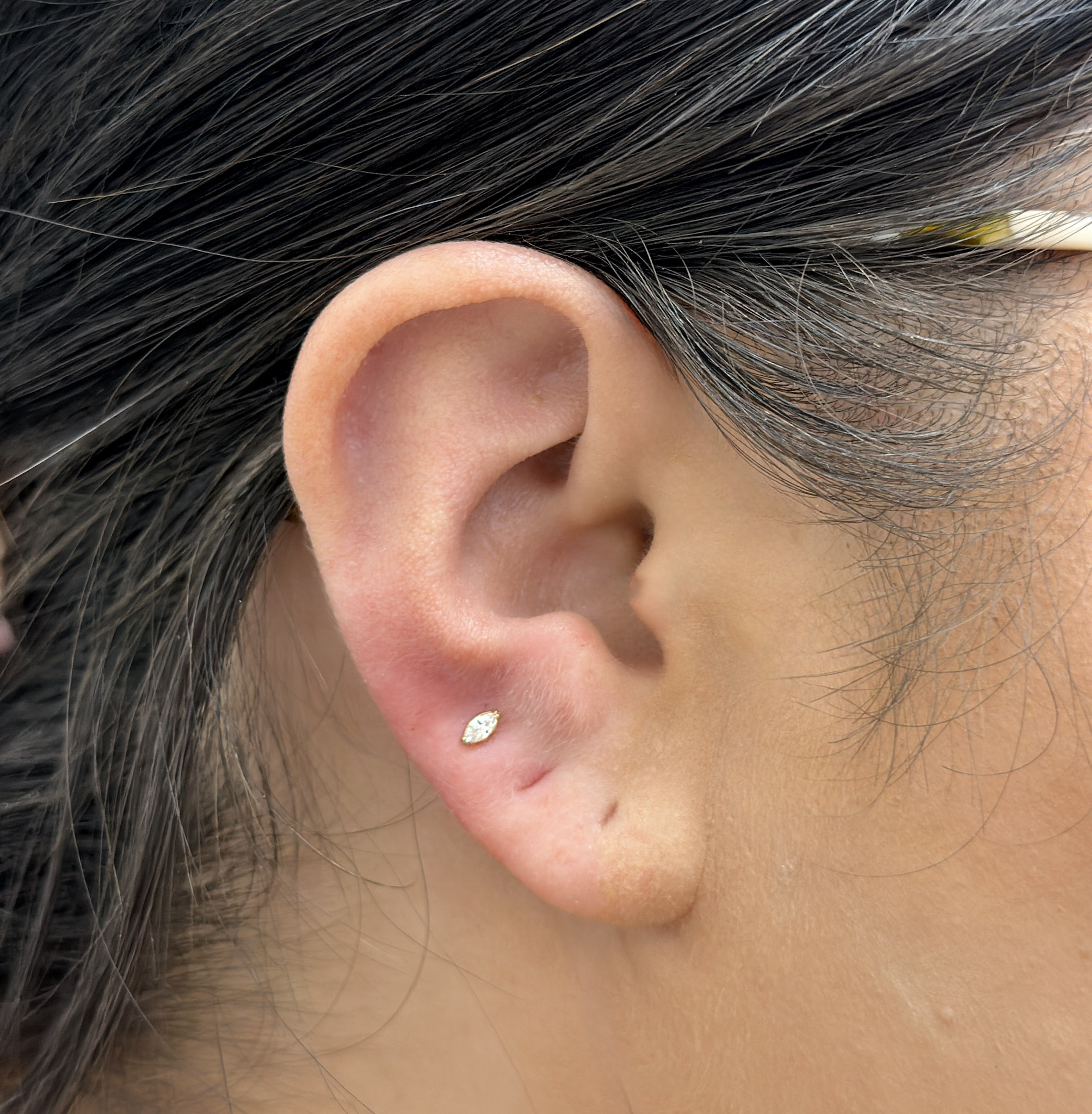 Lobes (Single/Double)