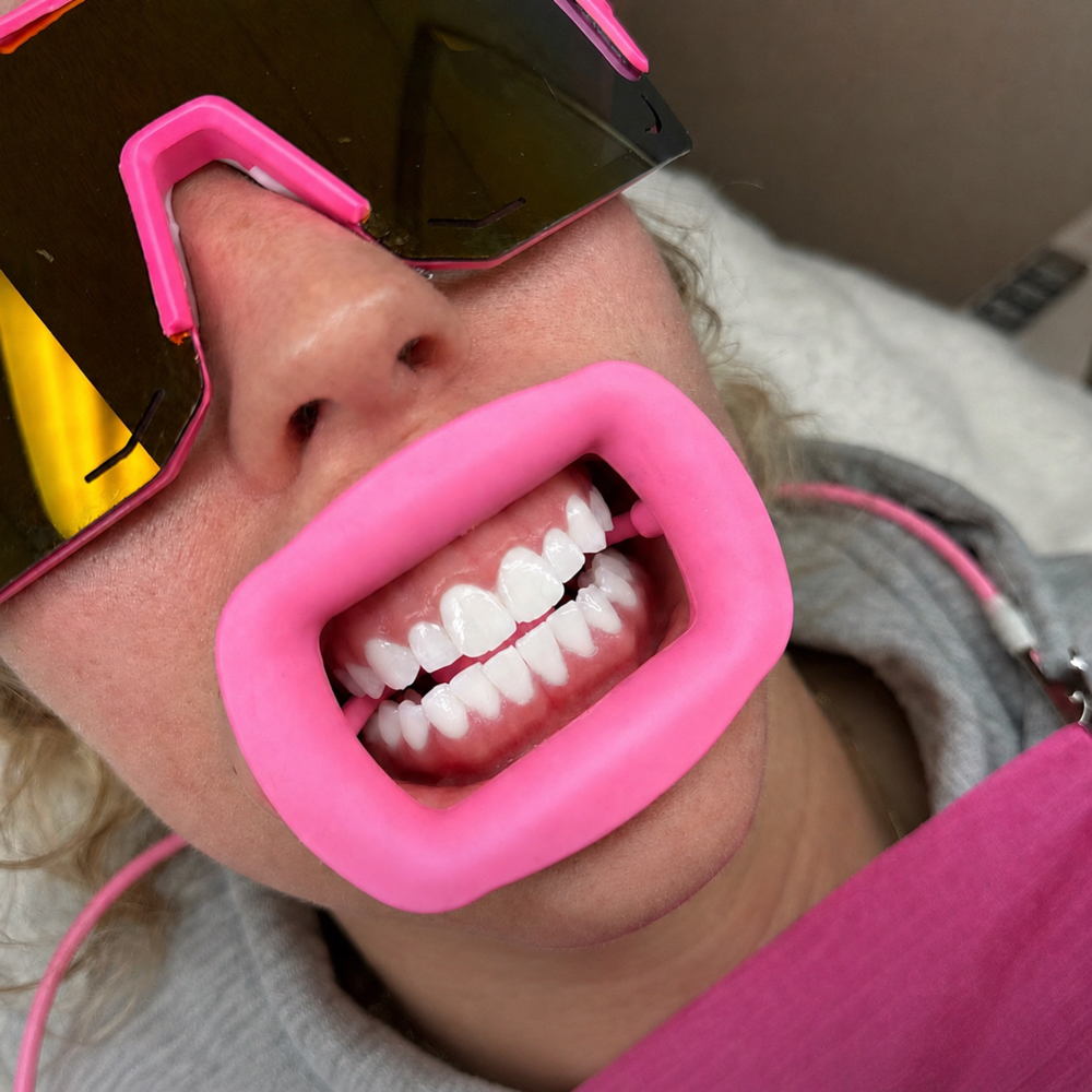 TEETH WHITENING 🦷 at DIVAS LIPS, LLC in Bethlehem, PA