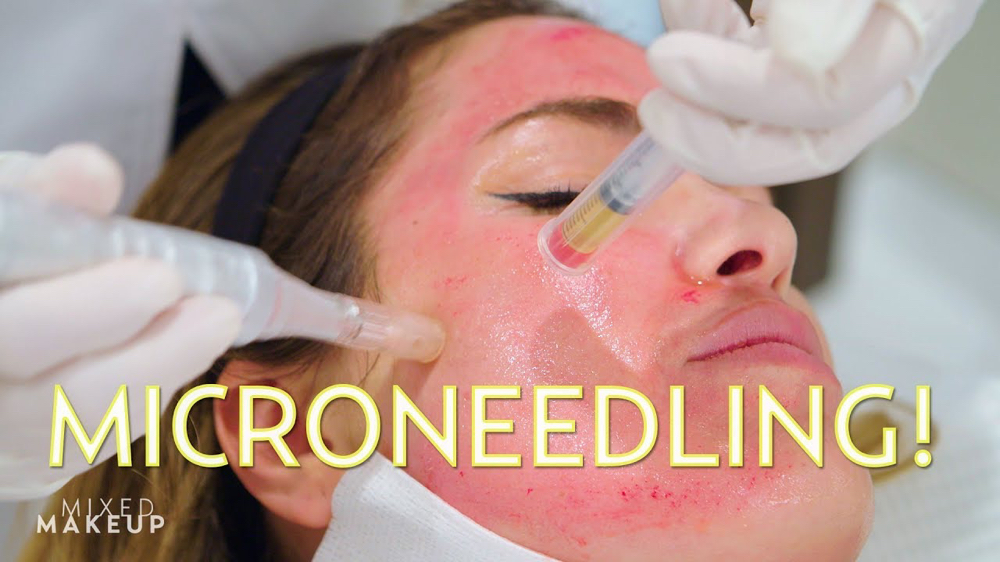 Microneedling PRP