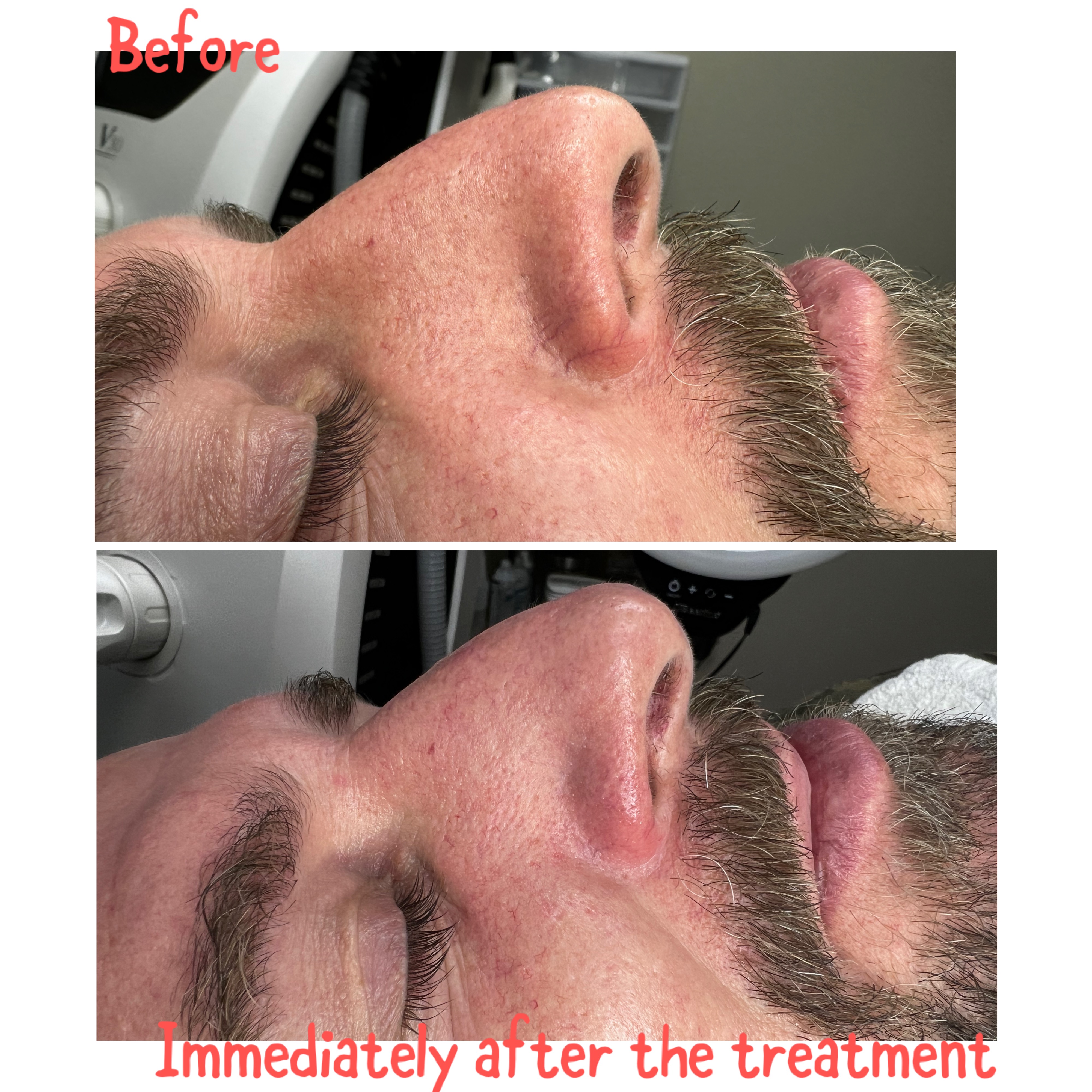 Vascular Lesion Treatment at Magnifique Laser Spa in Rockville Centre, NY