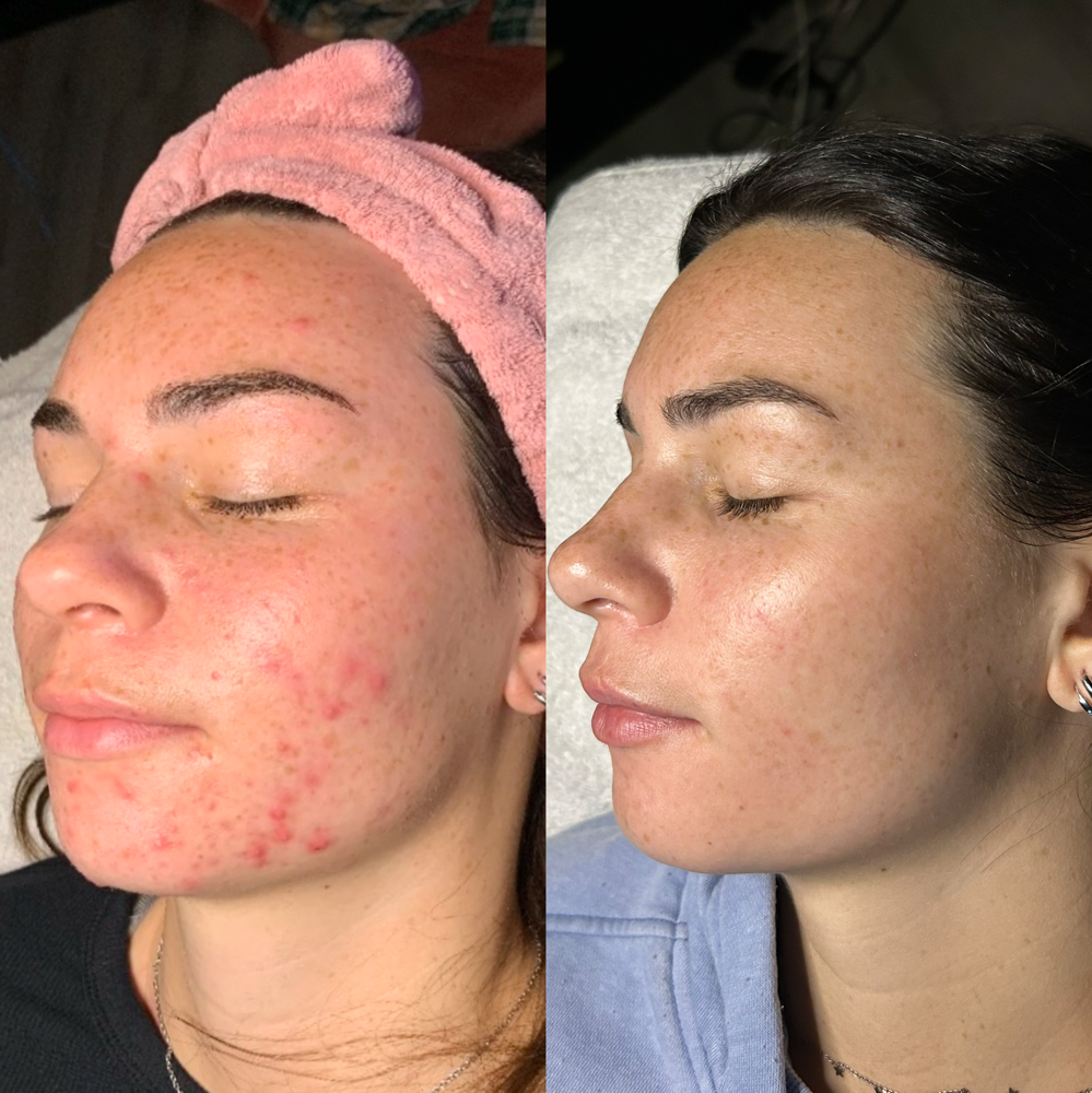 Face Reality Clear Skin Peel